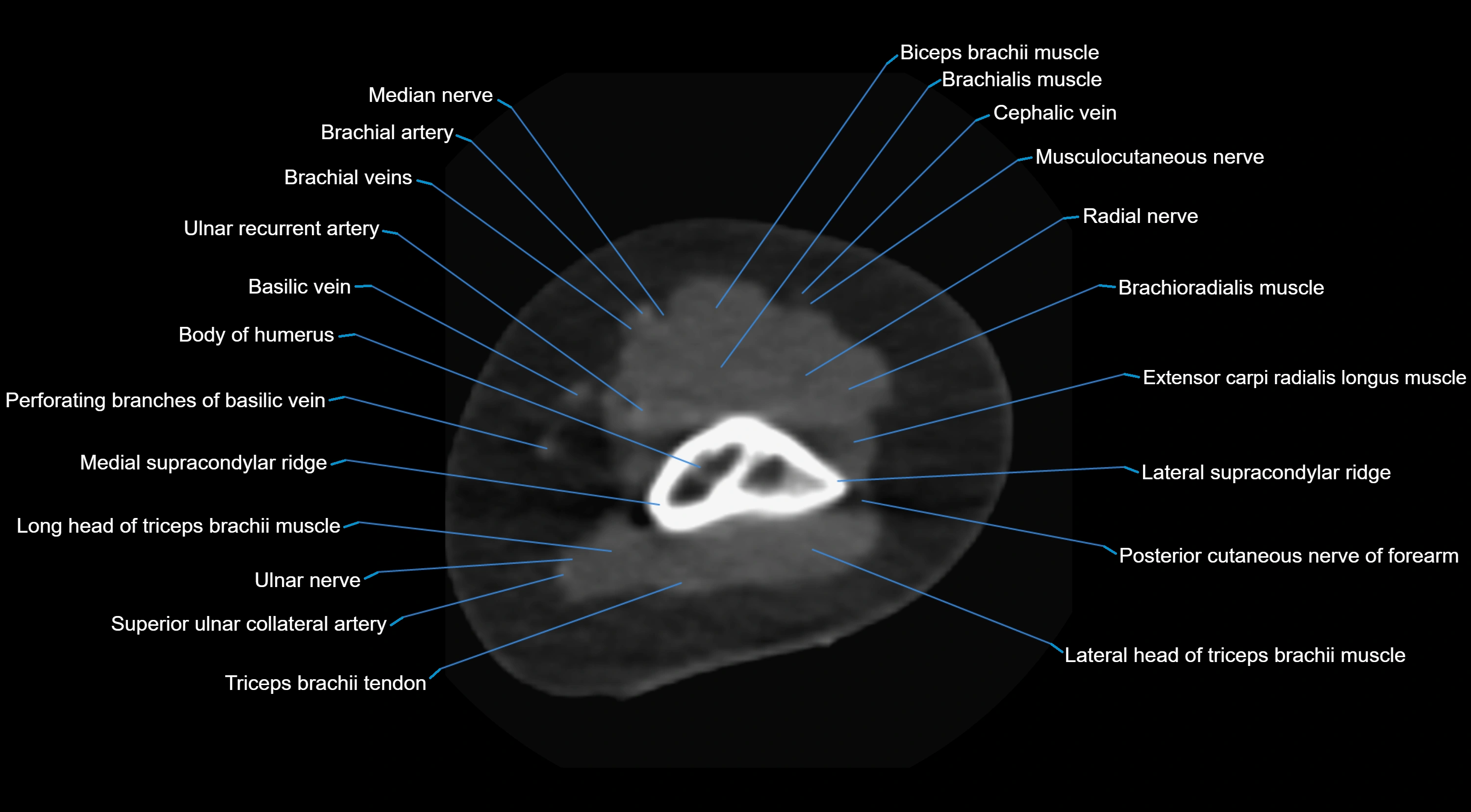 CT elbow axial  cross sectional anatomy labelled  radiology image -00006.webp